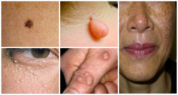 Natural-Ways-To-Destroy-Moles-Warts-Blackheads-Skin-Tags-And-Age-Spots