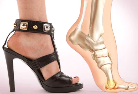 Các triệu chứng đau mỏi chân, nổi mạch máu, chuột rút thường được nghĩ như hiện tượng bình thường do đi lại nhiều, đi giày cao gót