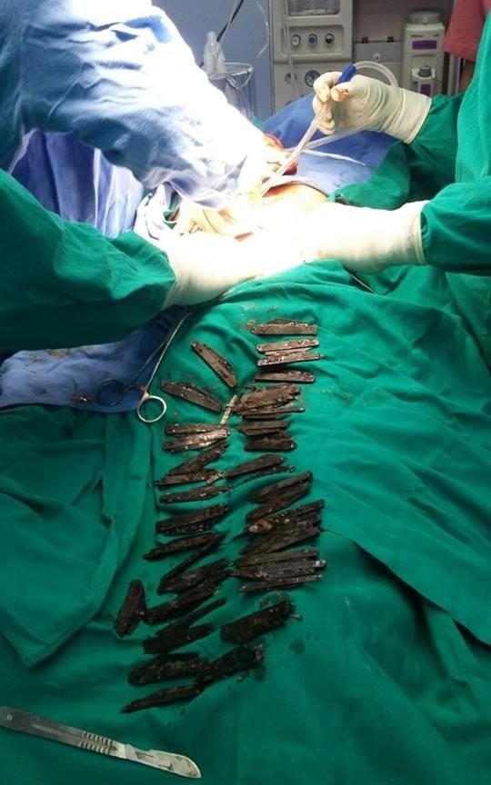 Các bác sĩ tiến hành lôi 40 con dao ra khỏi bụng bệnh nhân