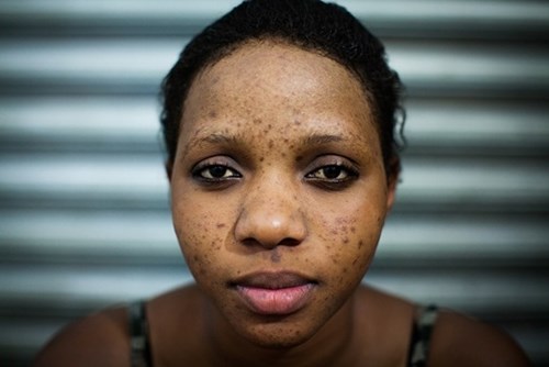 Aisha đắp mặt nạ ở thẩm mĩ viện. Trong vòng hai tháng, các mụn viêm nổi lên khắp mặt